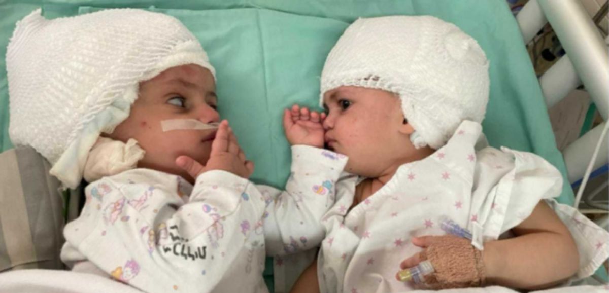 Pour la 1ere fois des médecins israéliens séparent des têtes de jumelles siamoises